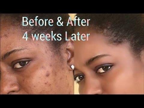 Scars, body acne, stretchmarks, dark marks, uneven tone