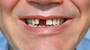 False Teeth / Dentures - Dental Material to make your own R100 a tooth 